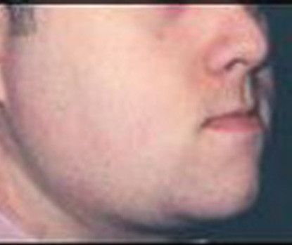 Male Facial Rejuvenation Before & After