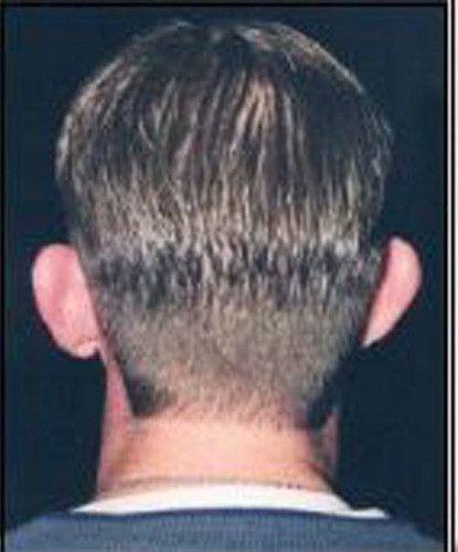 Male Facial Rejuvenation Before & After