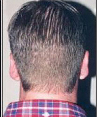 Male Facial Rejuvenation Before & After