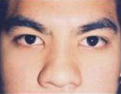 Male Facial Rejuvenation Before & After