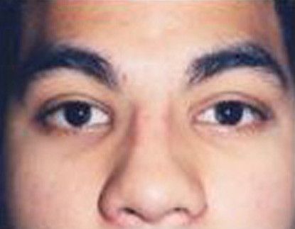 Male Facial Rejuvenation Before & After