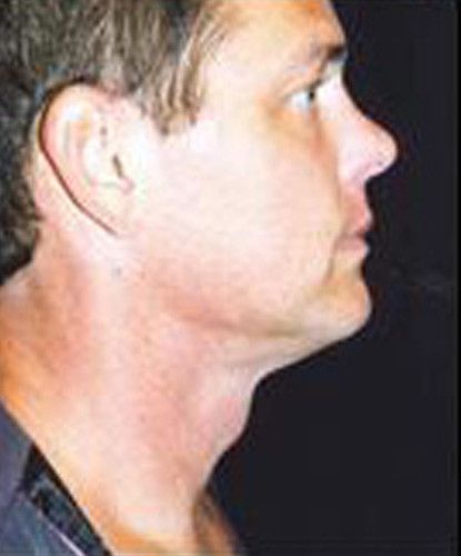 Male Facial Rejuvenation Before & After