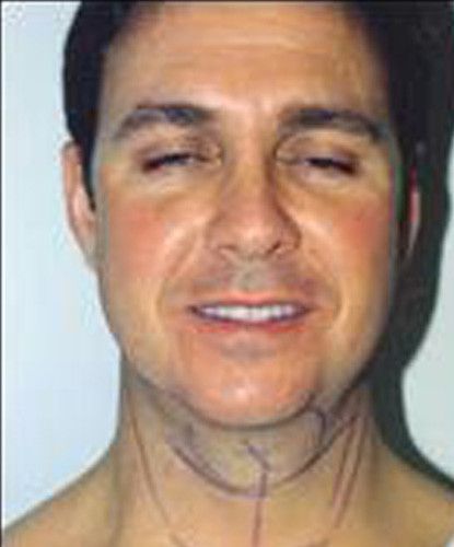 Male Facial Rejuvenation Before & After