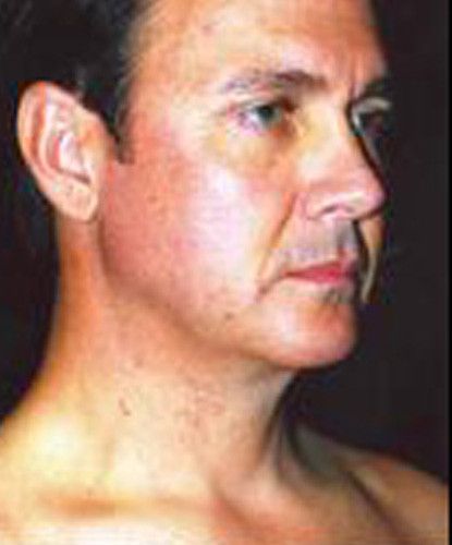 Male Facial Rejuvenation Before & After