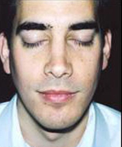 Male Facial Rejuvenation Before & After