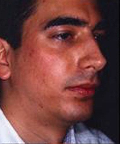 Male Facial Rejuvenation Before & After