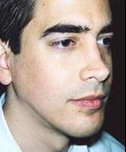 Male Facial Rejuvenation Before & After