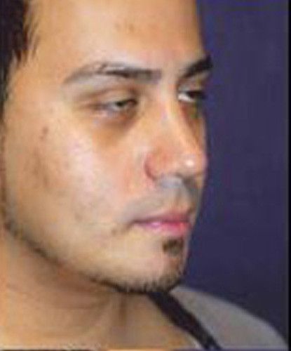 Male Facial Rejuvenation Before & After