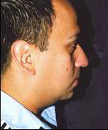 Male Facial Rejuvenation Before & After