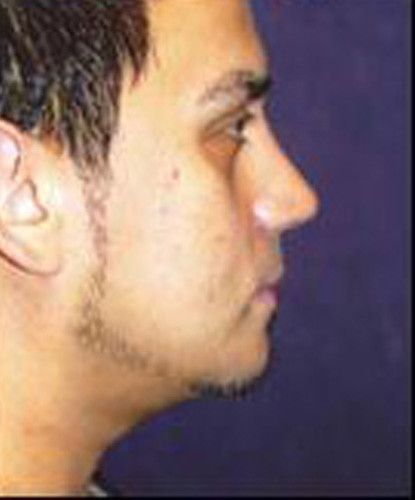 Male Facial Rejuvenation Before & After