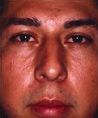 Male Facial Rejuvenation Before & After