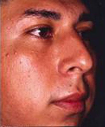 Male Facial Rejuvenation Before & After