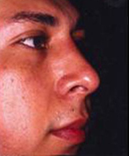 Male Facial Rejuvenation Before & After