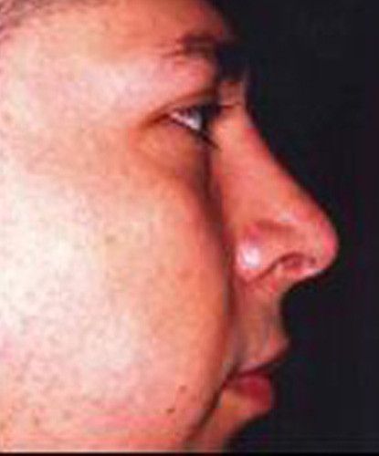 Male Facial Rejuvenation Before & After