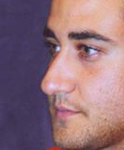 Male Facial Rejuvenation Before & After