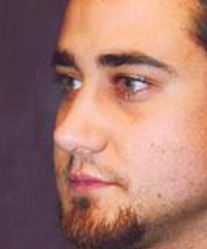 Male Facial Rejuvenation Before & After