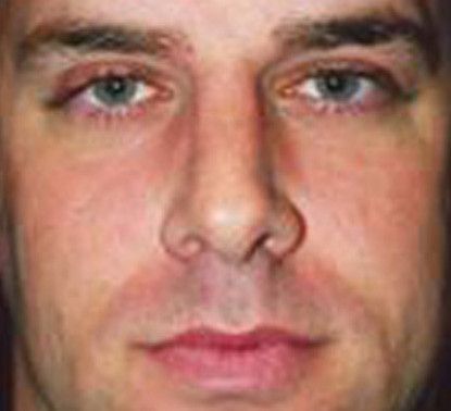 Male Facial Rejuvenation Before & After