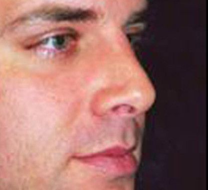 Male Facial Rejuvenation Before & After