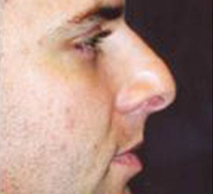 Male Facial Rejuvenation Before & After