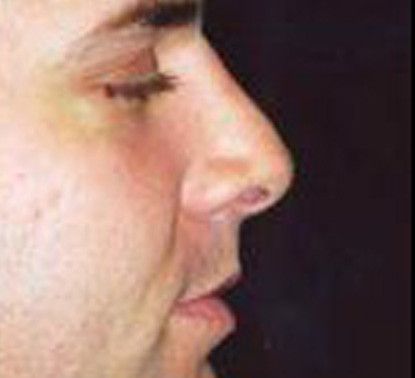 Male Facial Rejuvenation Before & After