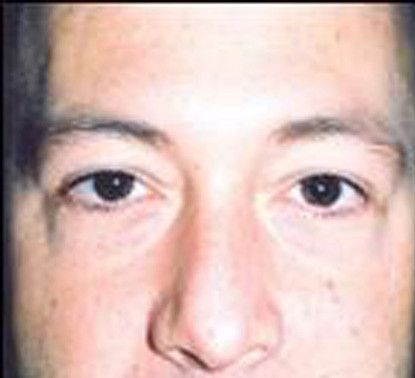 Male Facial Rejuvenation Before & After