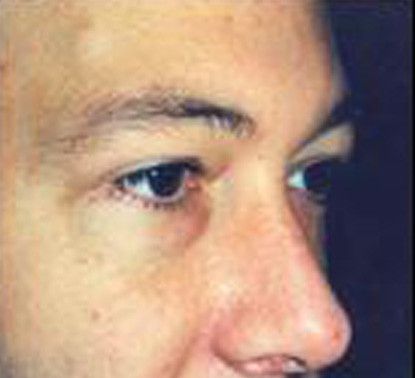 Male Facial Rejuvenation Before & After