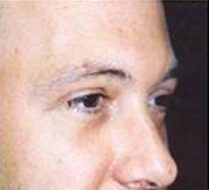 Male Facial Rejuvenation Before & After