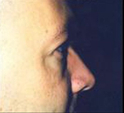 Male Facial Rejuvenation Before & After