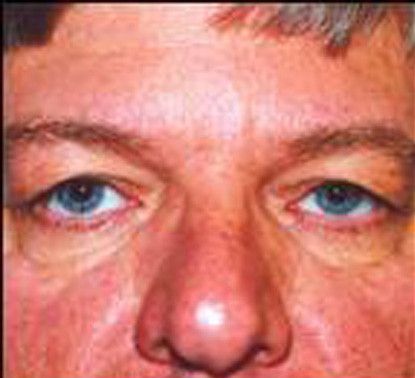 Male Facial Rejuvenation Before & After