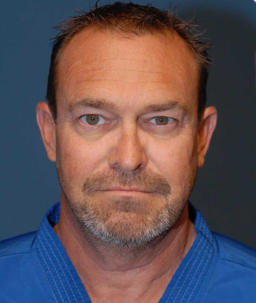 Male Facial Rejuvenation Before & After