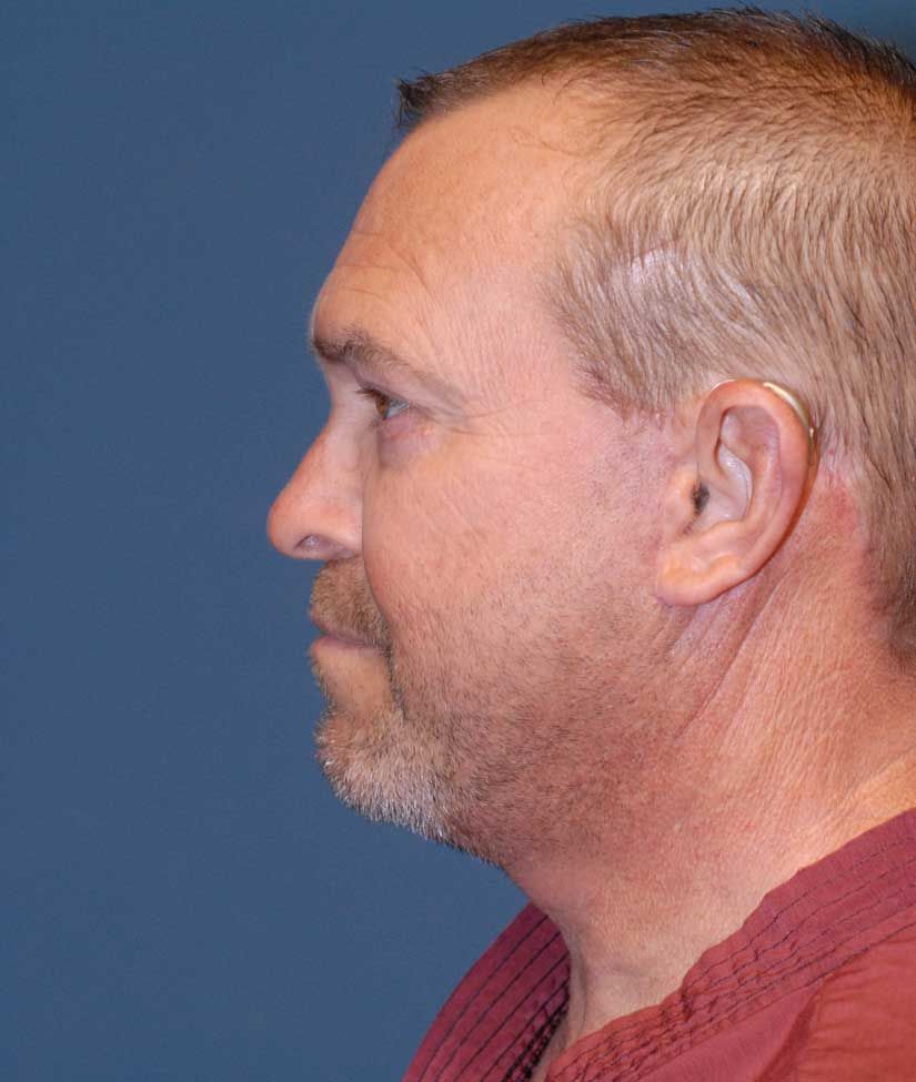 Male Facial Rejuvenation Before & After