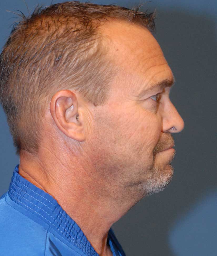 Male Facial Rejuvenation Before & After