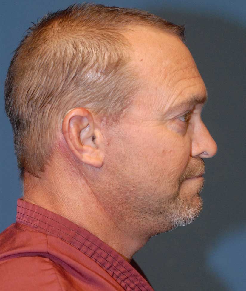 Male Facial Rejuvenation Before & After