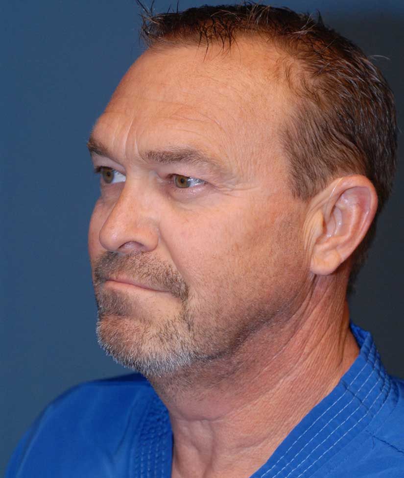 Male Facial Rejuvenation Before & After