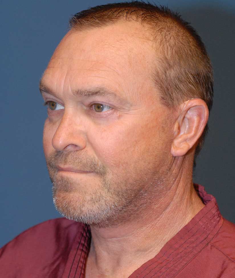 Male Facial Rejuvenation Before & After