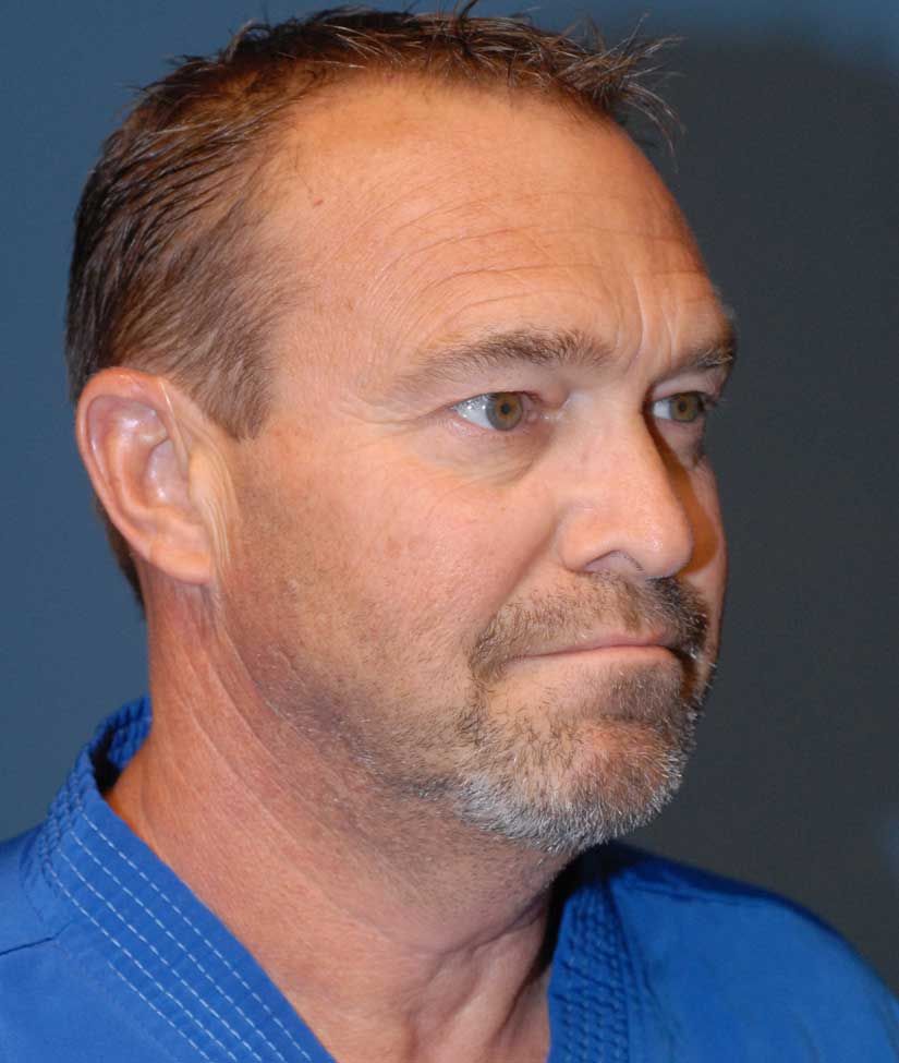 Male Facial Rejuvenation Before & After