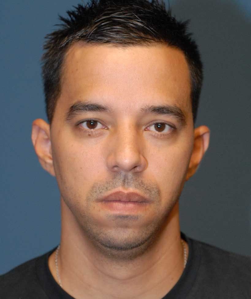 Male Facial Rejuvenation Before & After