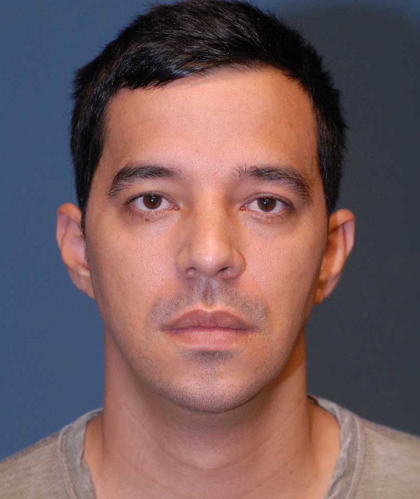 Male Facial Rejuvenation Before & After