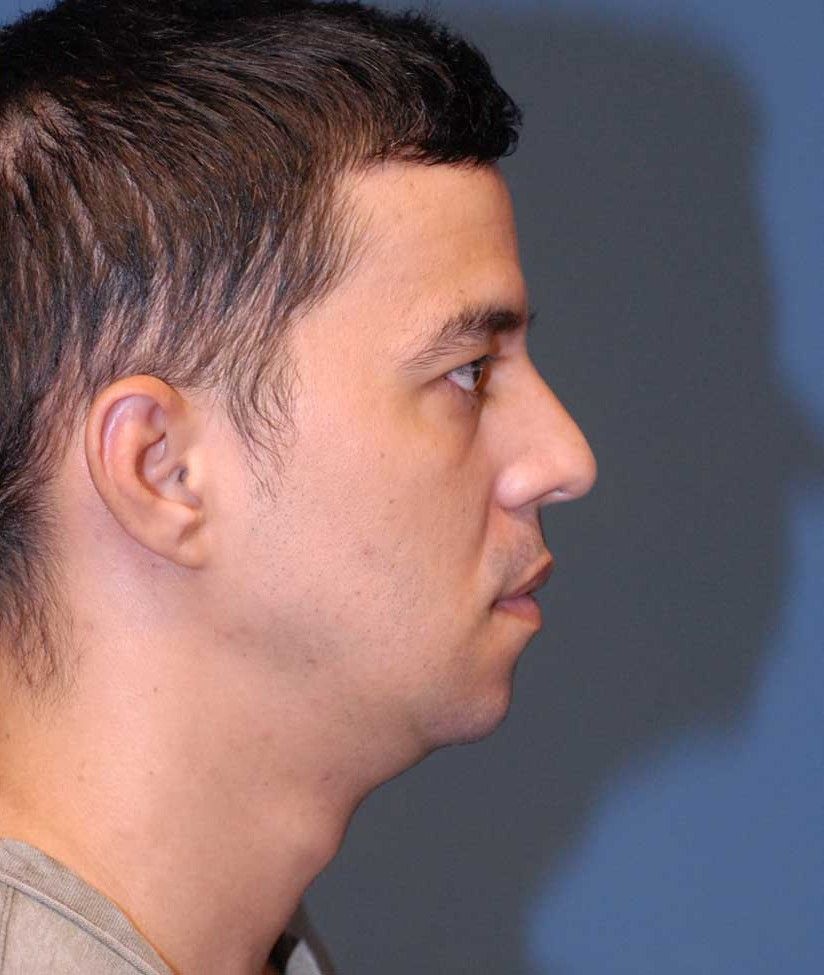 Male Facial Rejuvenation Before & After