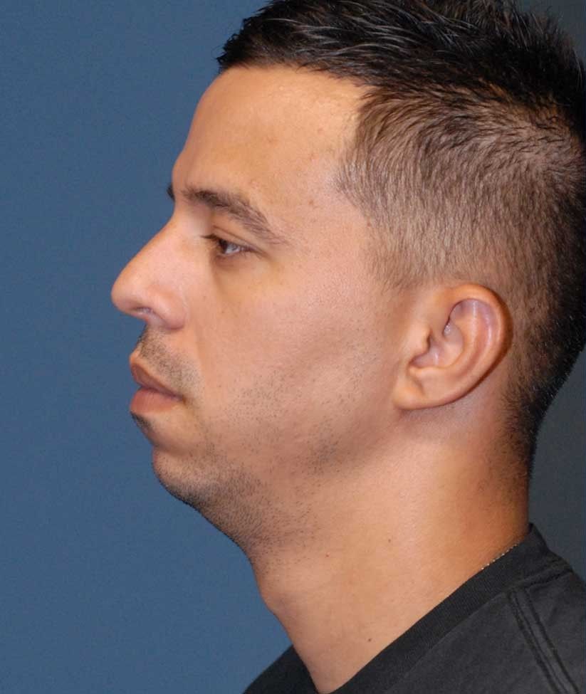 Male Facial Rejuvenation Before & After