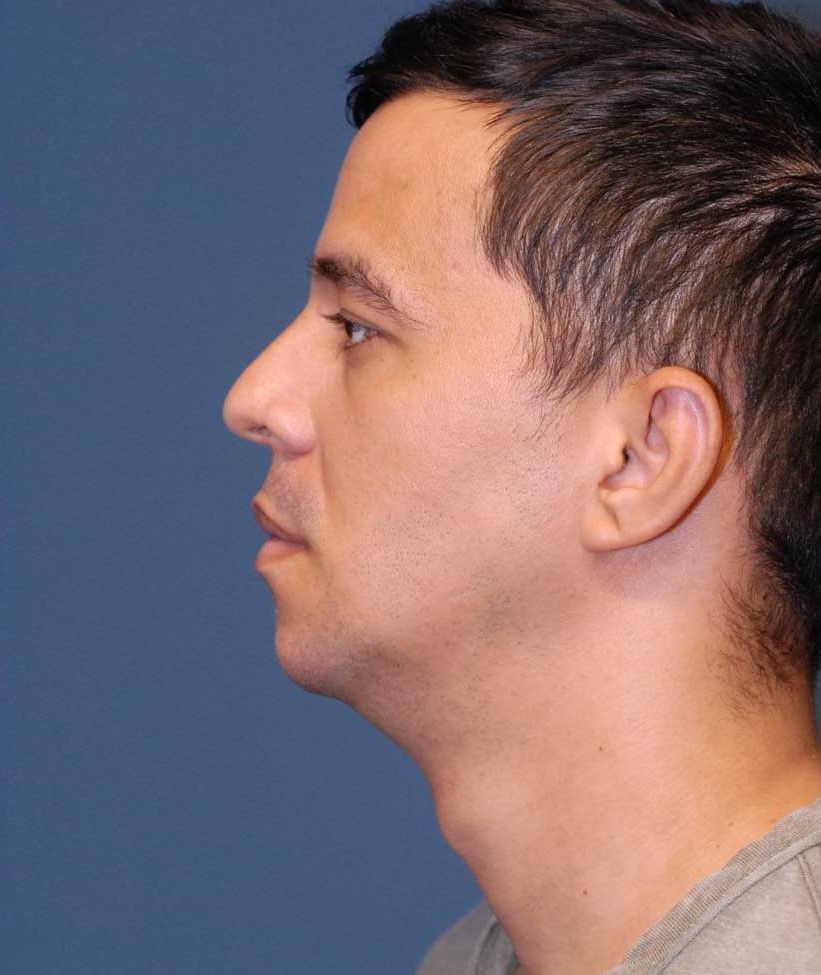 Male Facial Rejuvenation Before & After