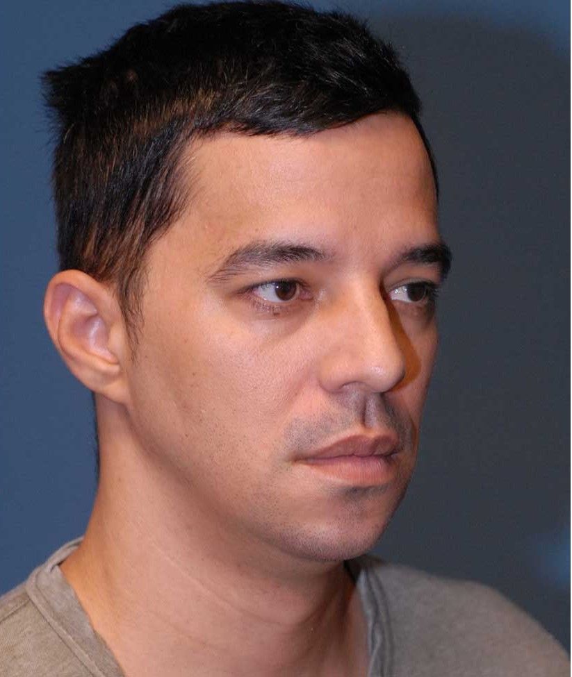 Male Facial Rejuvenation Before & After