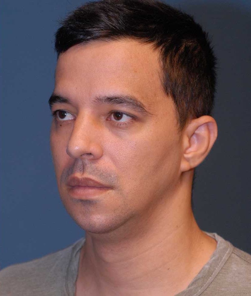 Male Facial Rejuvenation Before & After