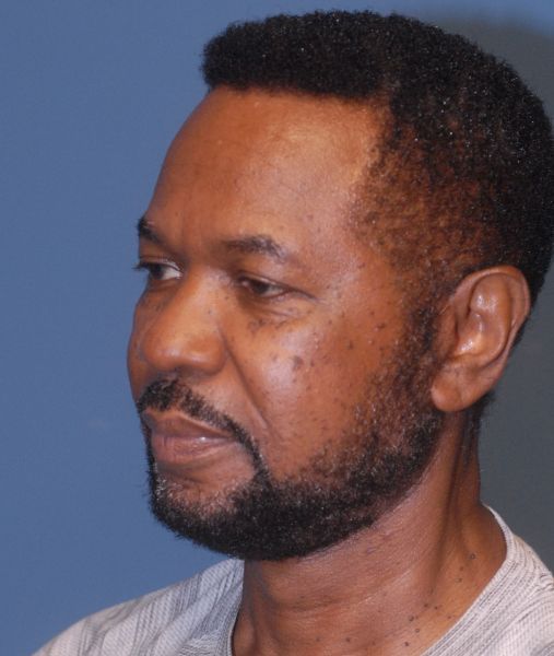 Male Facial Rejuvenation Before & After