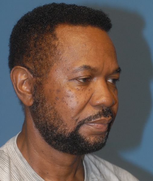 Male Facial Rejuvenation Before & After