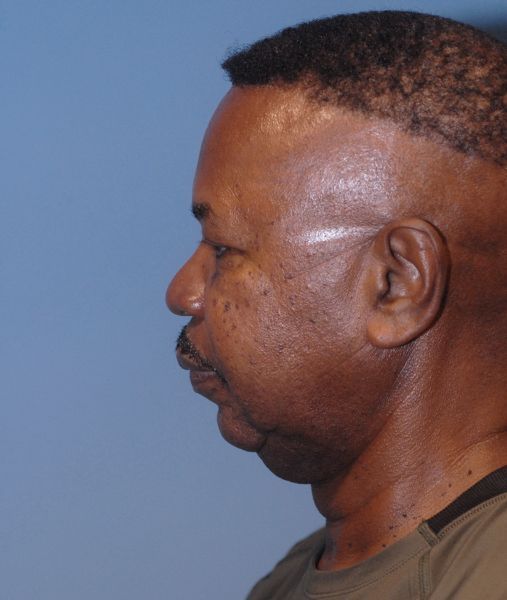 Male Facial Rejuvenation Before & After