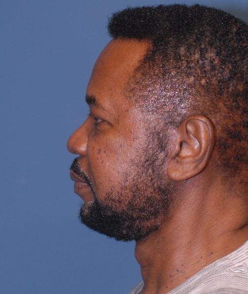 Male Facial Rejuvenation Before & After