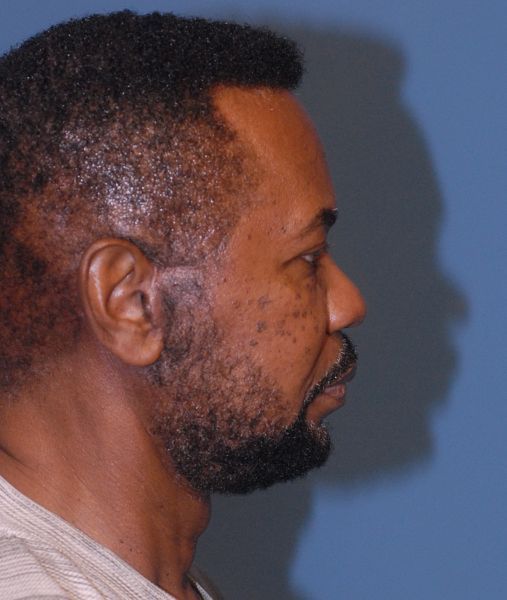 Male Facial Rejuvenation Before & After