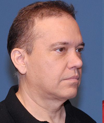 Male Facial Rejuvenation Before & After