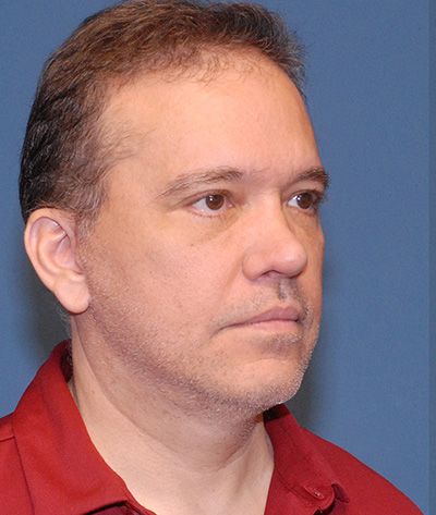 Male Facial Rejuvenation Before & After